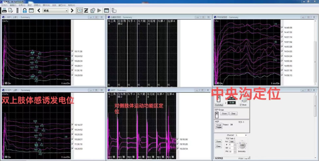 皇冠足球投注网
应用神经电生理监测技术辅助精准切除脑肿瘤