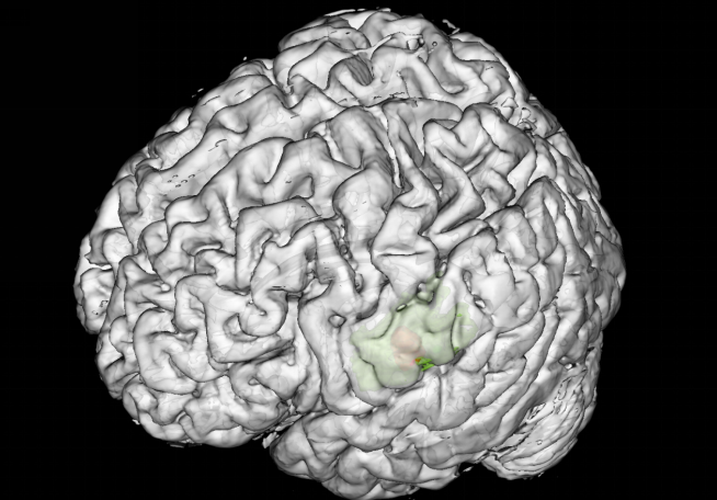 皇冠足球投注网
神经外科完成首例术中唤醒脑功能区癫痫病灶切除手术