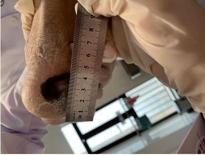 皇冠足球网
（自治区人民医院东院）开展首次护理远程会诊