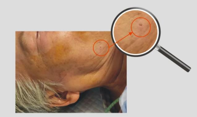 3D结构光机器人辅助经皮球囊压迫术在神经外科成功开展