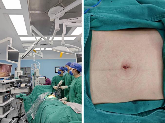 皇冠足球网
单孔腹腔镜术助患者实现“术后无痕”