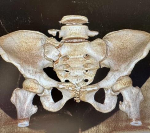 皇冠足球网
骨折微创固定技术大显身手