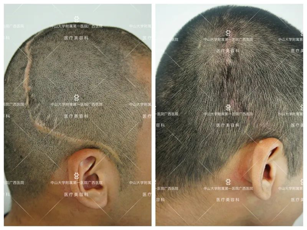 头上的疤痕可以用植发补救吗?皇冠足球网
自体毛发移植术助患者解决“头等大事”