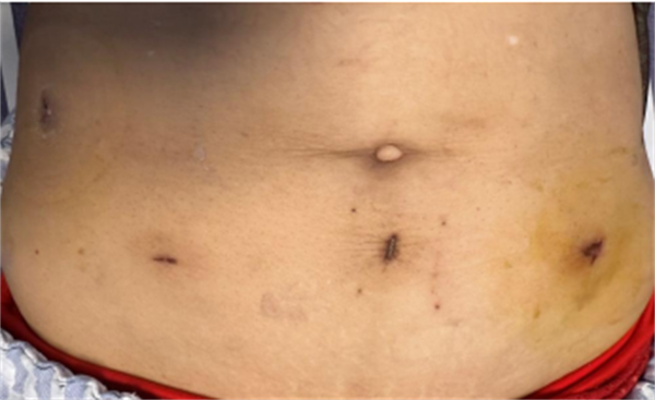 保质更微创 |皇冠足球网
应用NOSES术为结肠癌患者解病痛