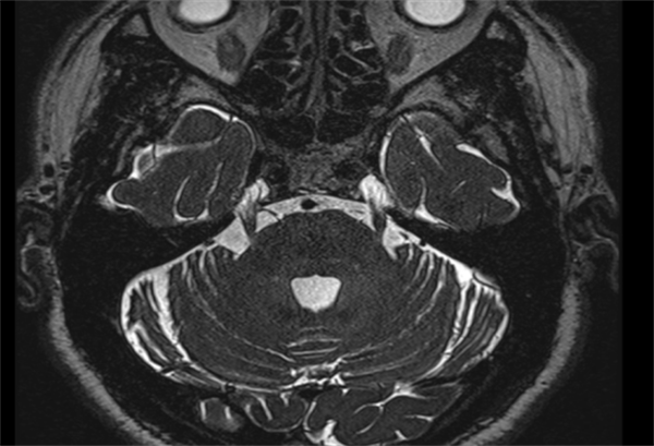 面部疼痛 饭都吃不下 | 皇冠足球投注网
纯内镜下微血管减压术一次性解决烦恼
