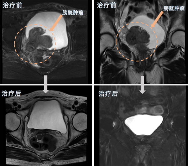 皇冠足球网
完成一例巨大膀胱癌高龄患者保留膀胱治疗