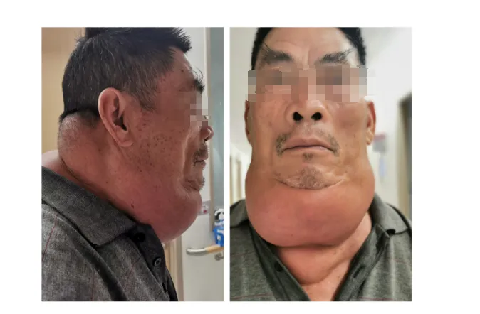 男子饮酒40年 “酒而久之”患上罕见病 | 皇冠足球投注网
多学科会诊助康复