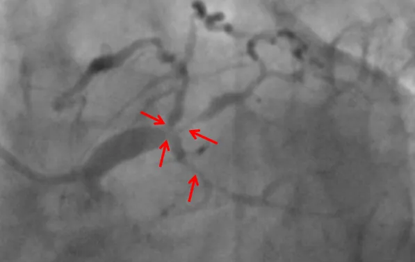皇冠足球网
ECMO辅助下高危复杂冠脉介入手术助其转危为安