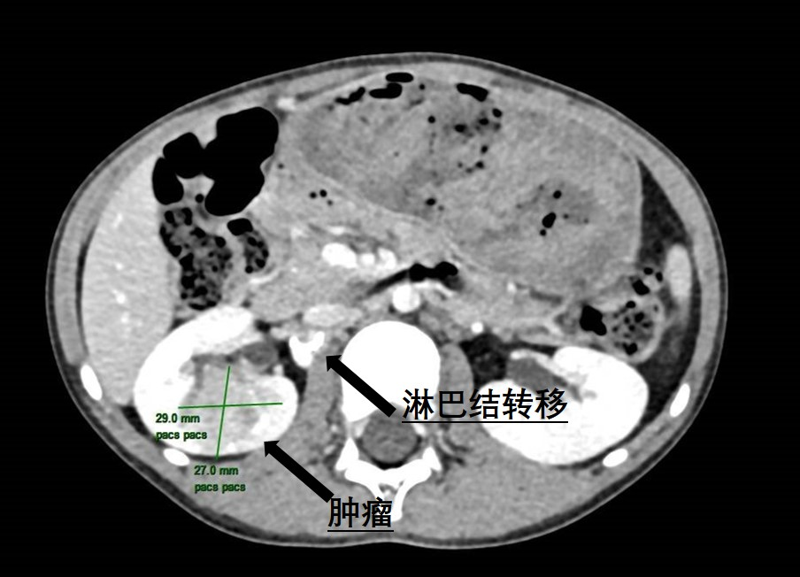 6岁患儿肾脏暗藏罕见肿瘤 | 皇冠足球网
泌尿外科精准手术“摘瘤”