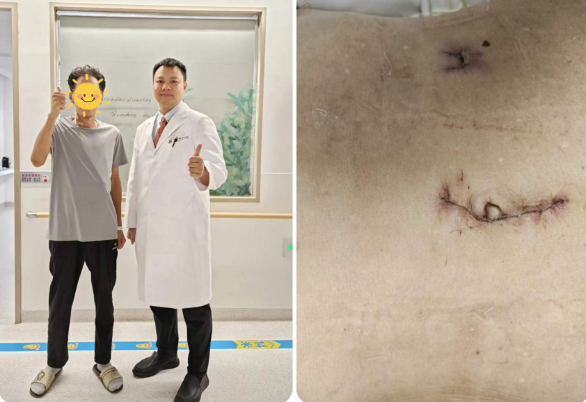 一个小切口，解决结肠癌 | 皇冠足球投注网
单孔+1腹腔镜下右半结肠癌根治术为七旬患者解忧