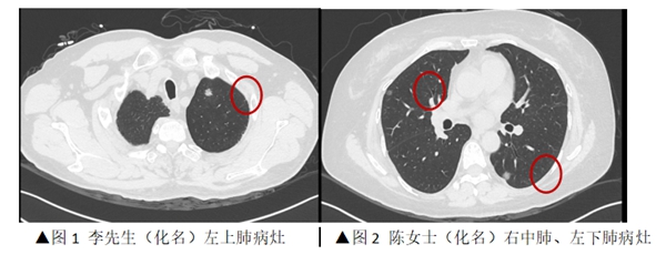 皇冠足球网
为一对“夫妻肺癌”患者进行同期微创手术治疗