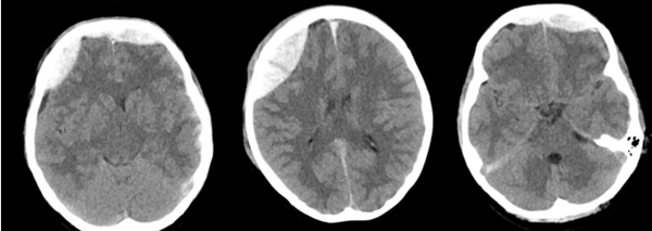 皇冠足球网
神经外科成功抢救颅脑外伤警员